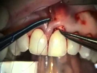 Periodontal Microsurgery: AlloDerm Root Coverage Grafting