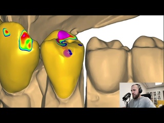 Exocad 3.1 rijeka modelling dental cad exocad video exocad Video Tutorial   Моделирование в exocad 2