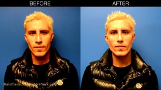 LA Male Model Makeover with Facial Filler by Dr. Steinbrech #6