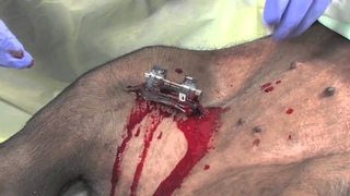 iTClamp on a live tissue model