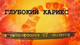 Глубокий КАРИЕС под пломбой и КИСТА верхнечелюстной пазухи на РАСШИФРОВКЕ КТ зубов (второе мнение)