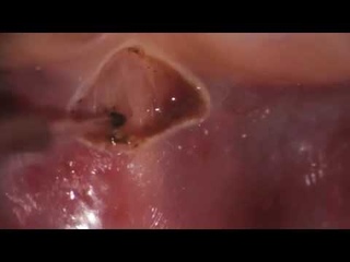 Frenectomy
