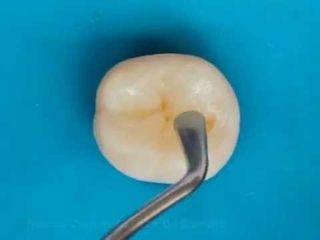 Restauração Dente Posterior em Resina Composta