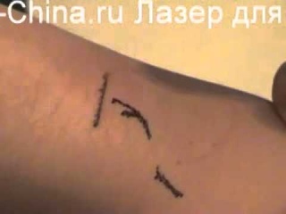 лазер_для_удаления_татуировки.mpg