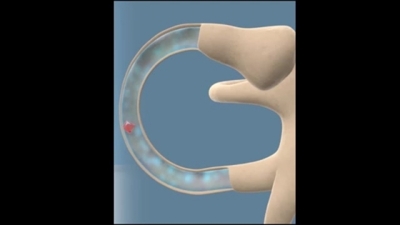 Epley Maneuver to Treat BPPV