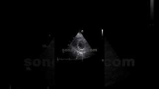 Ekokardiyografi - İnferolateral Ve İnferior Hipokinezi