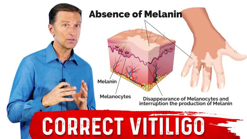 Fix Vitiligo With