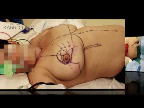 Wise Pattern ( Anchor Scar) Breast Reduction by Mr Vasu Karri. Live Surgery. Before after