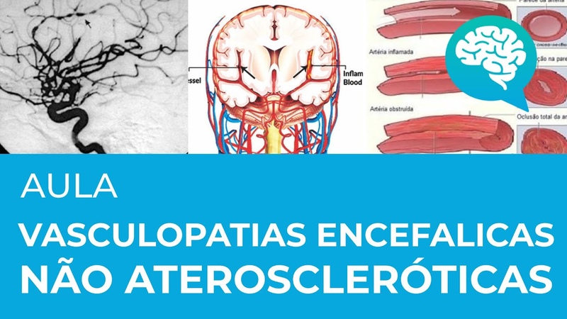 VASCULOPATIAS ENCEFÁ LICAS NÃ O ATEROSCLERÓ TICAS,